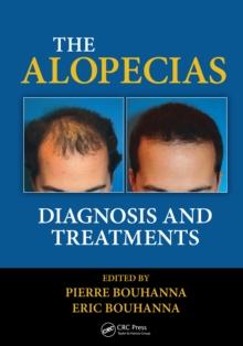 The Alopecias : Diagnosis and Treatments