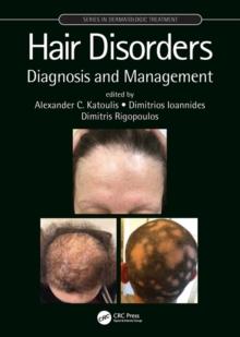 Hair Disorders : Diagnosis and Management