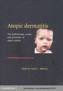 Atopic Dermatitis : The Epidemiology, Causes and Prevention of Atopic Eczema