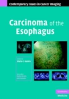 Carcinoma of the Esophagus