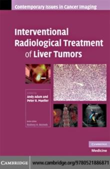 Interventional Radiological Treatment of Liver Tumors