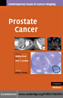 Prostate Cancer