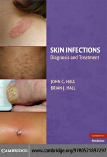 Skin Infections : Diagnosis and Treatment