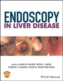 Endoscopy in Liver Disease