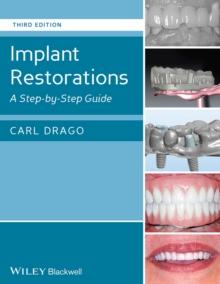 Implant Restorations : A Step-by-Step Guide