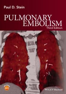 Pulmonary Embolism