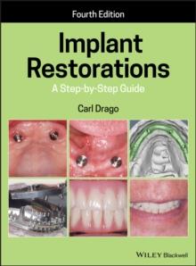 Implant Restorations : A Step-by-Step Guide