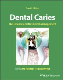 Dental Caries : The Disease and its Clinical Management