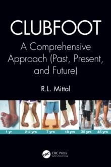 Clubfoot : A Comprehensive Approach (Past, Present, and Future)