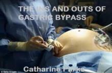 Ins and Outs of Gastric Bypass