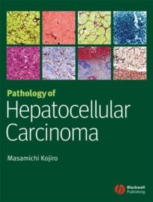 Pathology of Hepatocellular Carcinoma