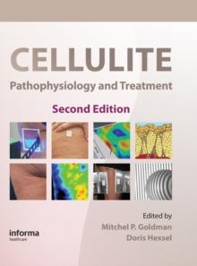 Cellulite : Pathophysiology and Treatment