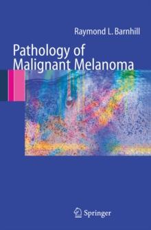 Pathology of Malignant Melanoma