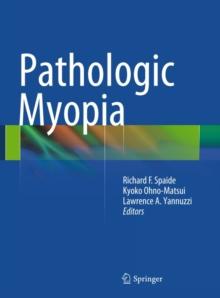 Pathologic Myopia