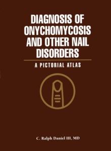 Diagnosis of Onychomycosis and Other Nail Disorders : A Pictorial Atlas