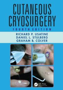 Cutaneous Cryosurgery