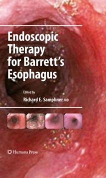 Endoscopic Therapy for Barrett's Esophagus