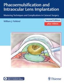 Phacoemulsification and Intraocular Lens Implantation : Mastering Techniques and Complications in Cataract Surgery