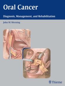 Oral Cancer : Diagnosis, Management, and Rehabilitation