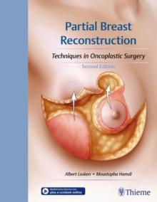 Partial Breast Reconstruction : Techniques in Oncoplastic Surgery