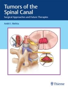 Tumors of the Spinal Canal : Surgical Approaches and Future Therapies