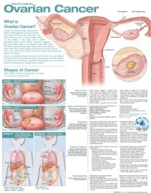 Understanding Ovarian Cancer Anatomical Chart