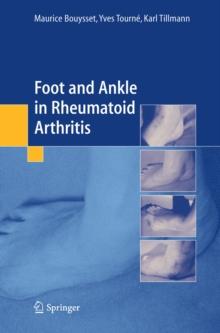 Foot and ankle in rheumatoid arthritis