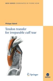 Tendon transfer for irreparable cuff tear