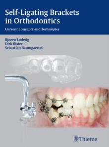 Self-Ligating Brackets in Orthodontics : Current Concepts and Techniques