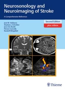 Neurosonology and Neuroimaging of Stroke : A Comprehensive Reference