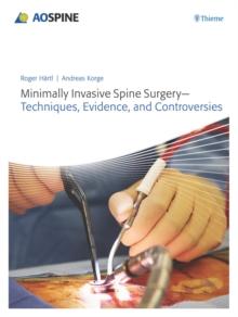 Minimally Invasive Spine Surgery - Techniques, Evidence, and Controversies