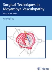 Surgical Techniques in Moyamoya Vasculopathy : Tricks of the Trade