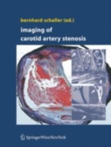 Imaging of Carotid Artery Stenosis