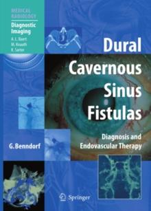 Dural Cavernous Sinus Fistulas : Diagnosis and Endovascular Therapy