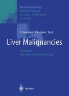 Liver Malignancies : Diagnostic and Interventional Radiology