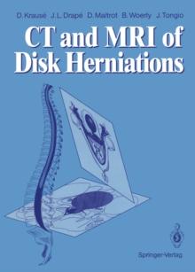 CT and MRI of Disk Herniations