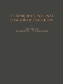 Technique of Internal Fixation of Fractures