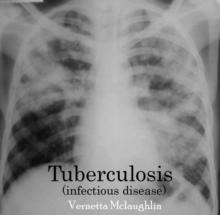 Tuberculosis(infectious disease)