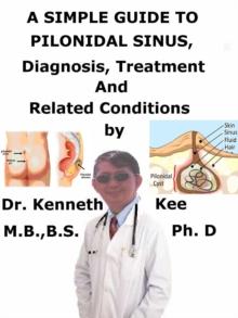 Simple Guide to Pilonidal Sinus, Diagnosis, Treatment and Related Conditions