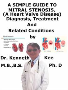 Simple Guide to Mitral Stenosis (A Heart Valve Disease), Diagnosis, Treatment and Related Conditions