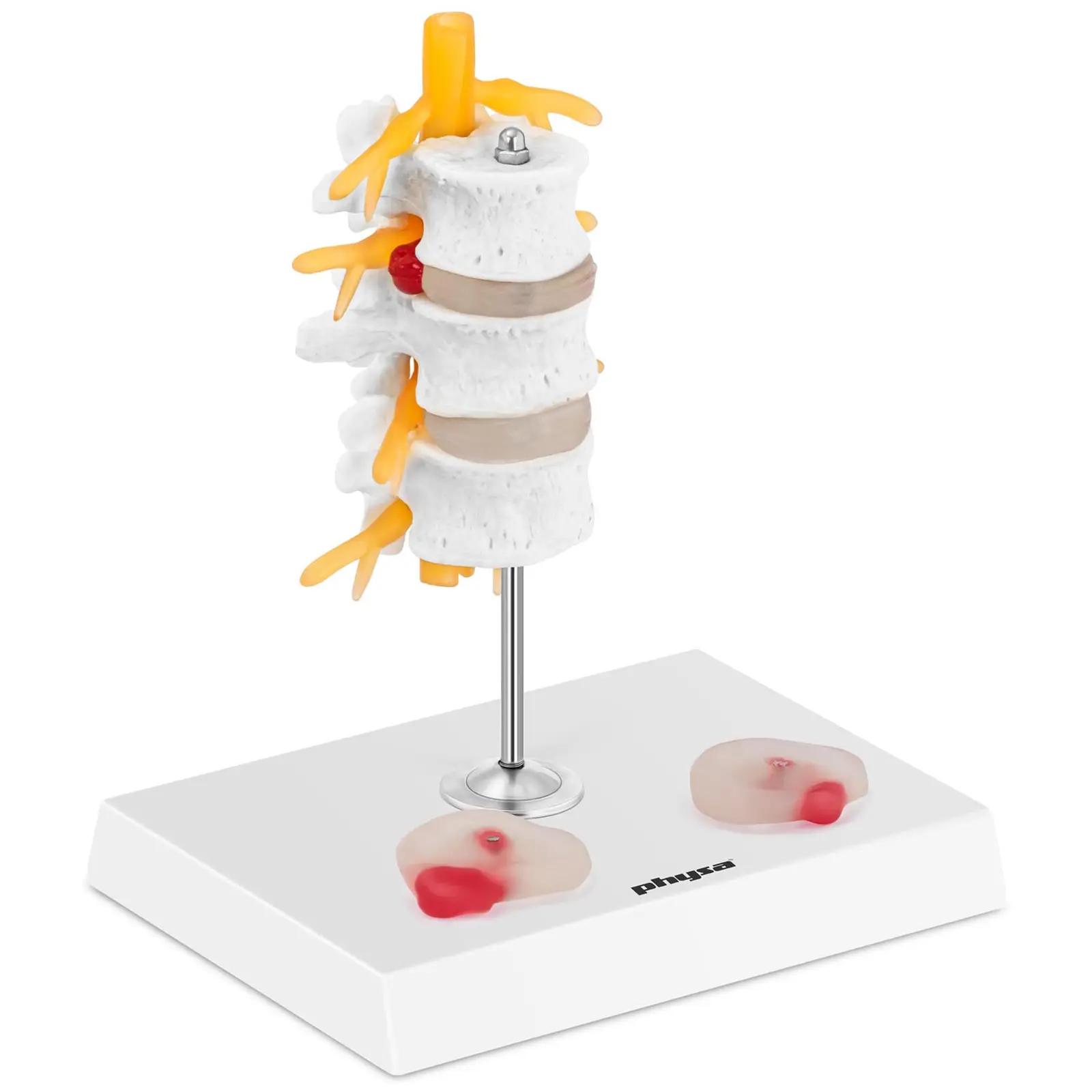 Intervertebral Disc Model - slipped disc - colour