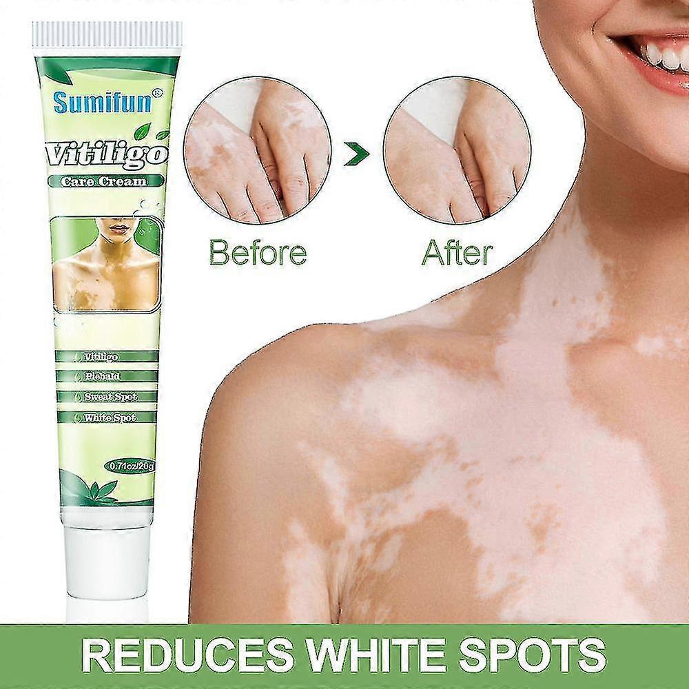 Syhww White Tag Treatment Cream For Reduces White Spots Skin Vitiligo Skin Care