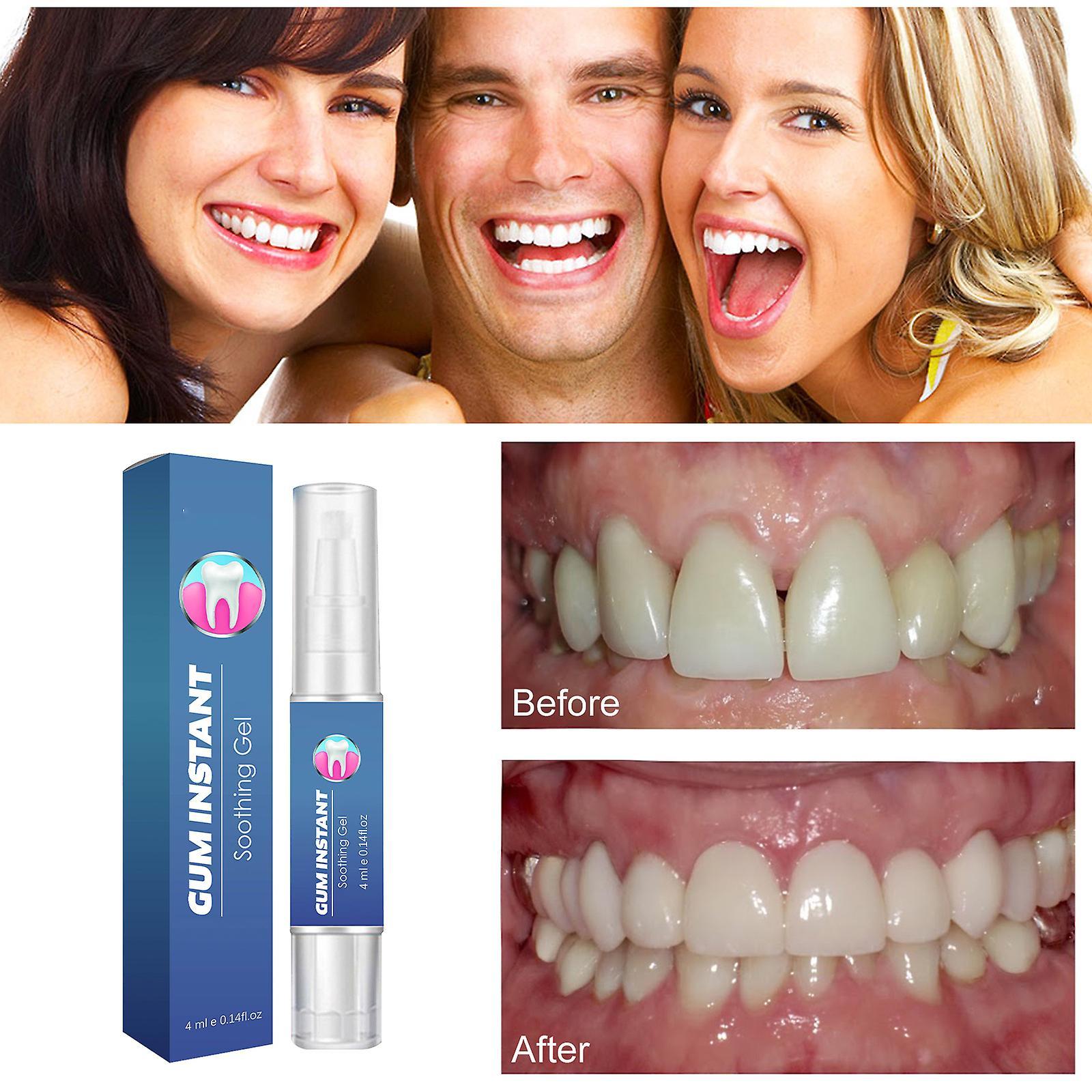 Fongwan Gum Therapy Gel, Gum Therapy Gel Pen, Safe And Effective Teeth Whitening Gel, Nature Teeth Whitening Essence Pen 3pcs