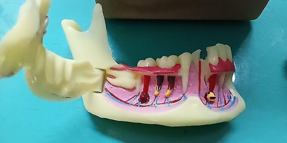 Slowmoose Anatomical Model Of Gingival Nerve-teeth Model For Dental Study