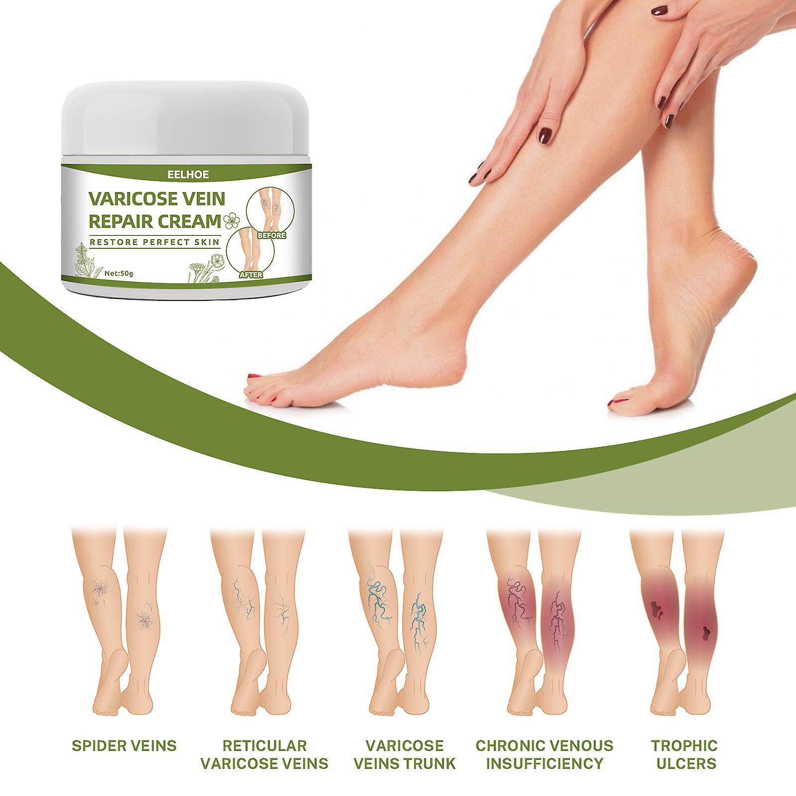 Gaoguang Varicose Vein Cream 50g Varicose Vein Cream Anti-Spider Veins And Spider Vein Removal Varicose Veins Leg Ointment Mardi Gras Gifts White