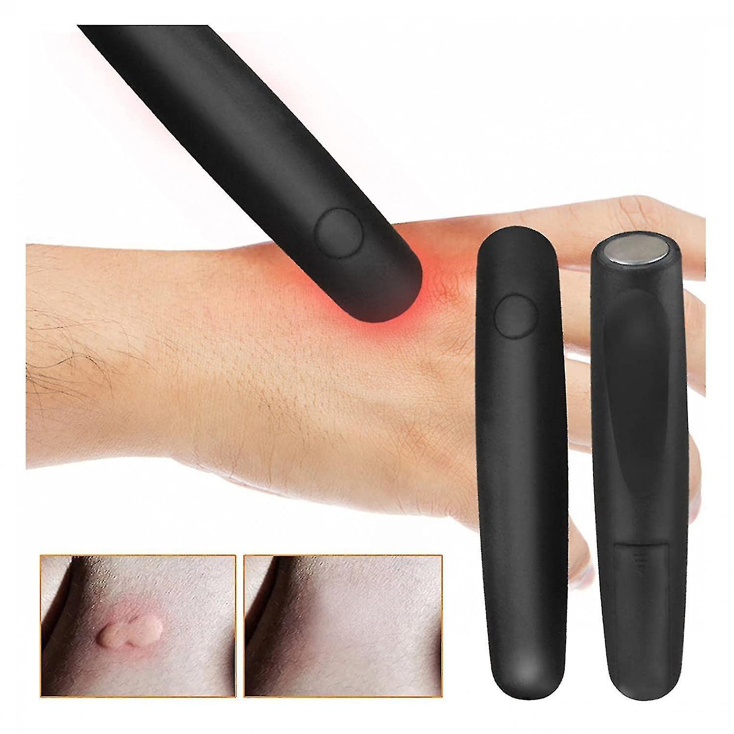 Sjjyv Good quality Electronic Mosquito Bite Pens Insect Bite Healer Anti-Itch Treatment Tool,Insect Sting And Bite Relief,Chemical Free, Kid Friend...