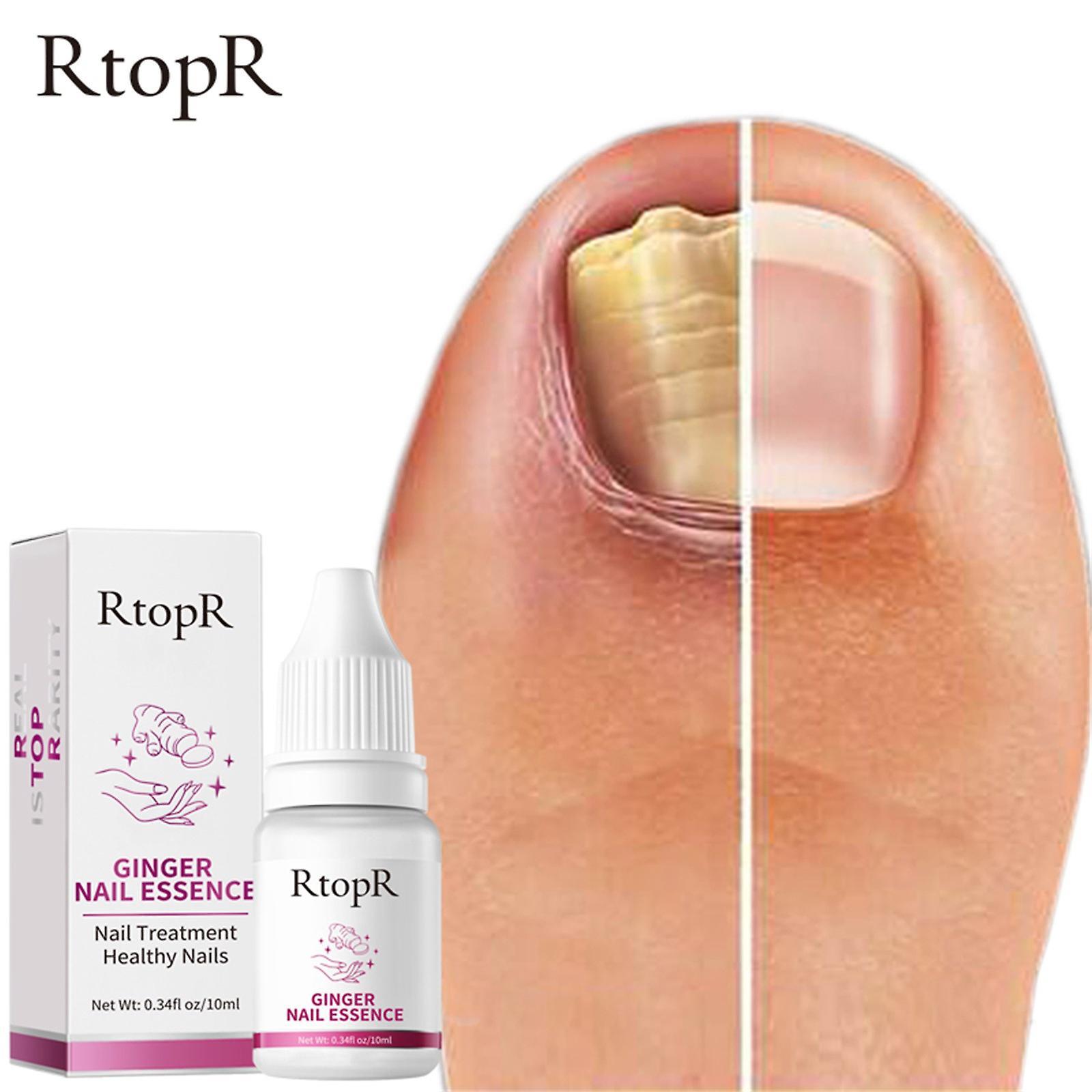 Congjing RtopR Ginger Nail Treat Ment  Nail Toe Repair 10ml