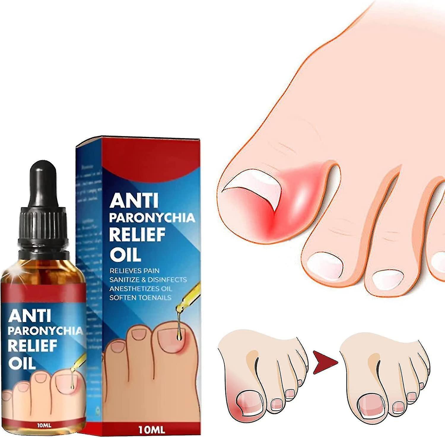 Frusde Anti Paronychia Relief Oil, Anti-paronychia Auxiliary Oil, Ingrown Toenail Correction, Nail Care Oils For Ingrown Toenails 1pcs