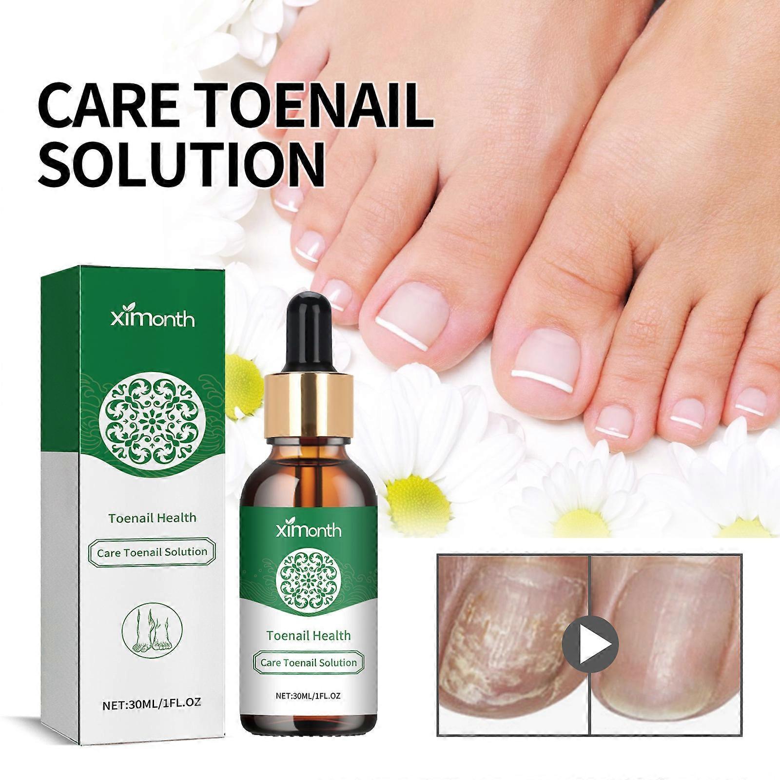 Unbrand Toenail Care Solution Hand and Foot Nail Repair Bright Nail Funguss Soft Nail Ingrown Toenail Care Solution 30ml Repair Brightening Nails O...