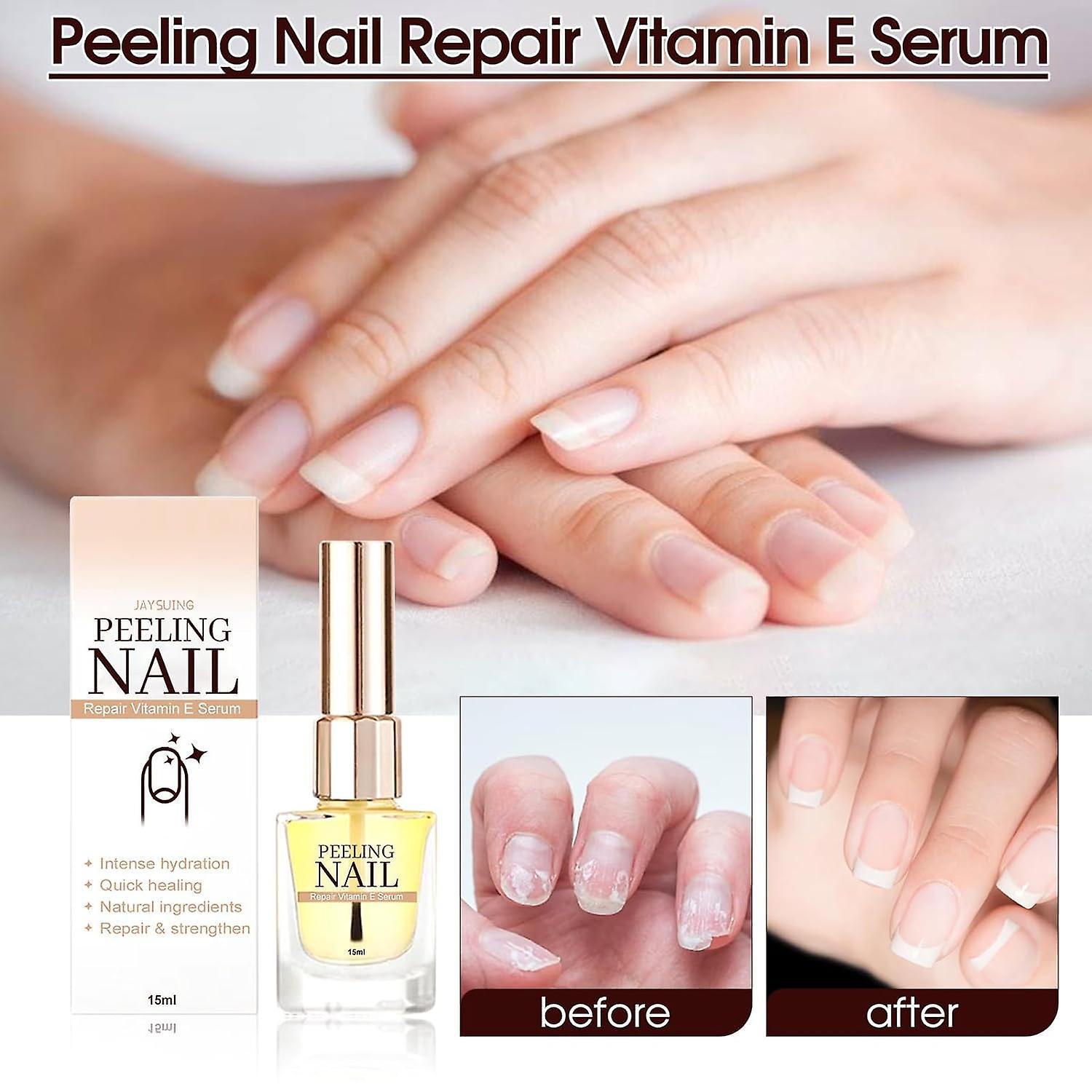 Antbaba Peeling Nail Therapy Vitamin E Serum, Vitamin E Nail and Cuticle Oil, Nail Cuticle Oil Vitamin E, Cuticle Oil for Nails, Nourish Dry Damage...